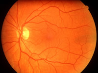 retinal photo