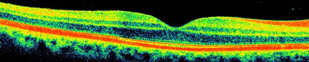 OCT Optical Coherence Tomography Scan