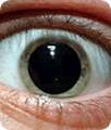 dilated pupil eye